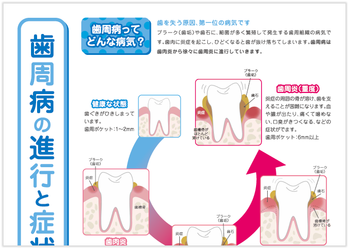 患者向け説明資料 歯周病の進行と症状